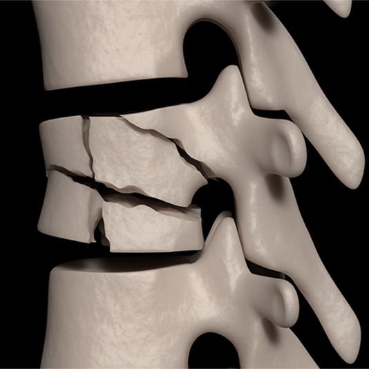 spine fracture treatment in chennai