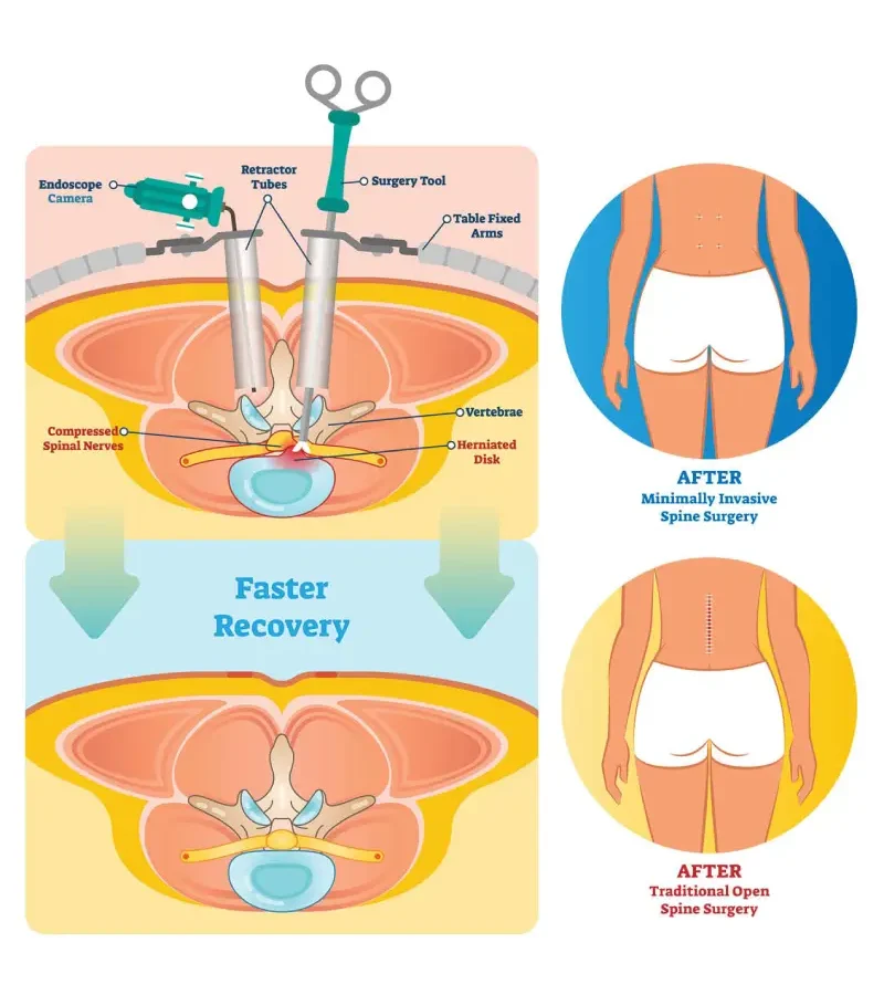 Minimally Invasive Spine Surgery Specialist in Chennai